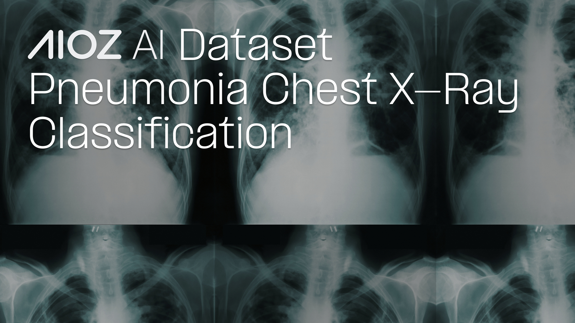 Pneumonia_Chest_X_Ray_Dataset