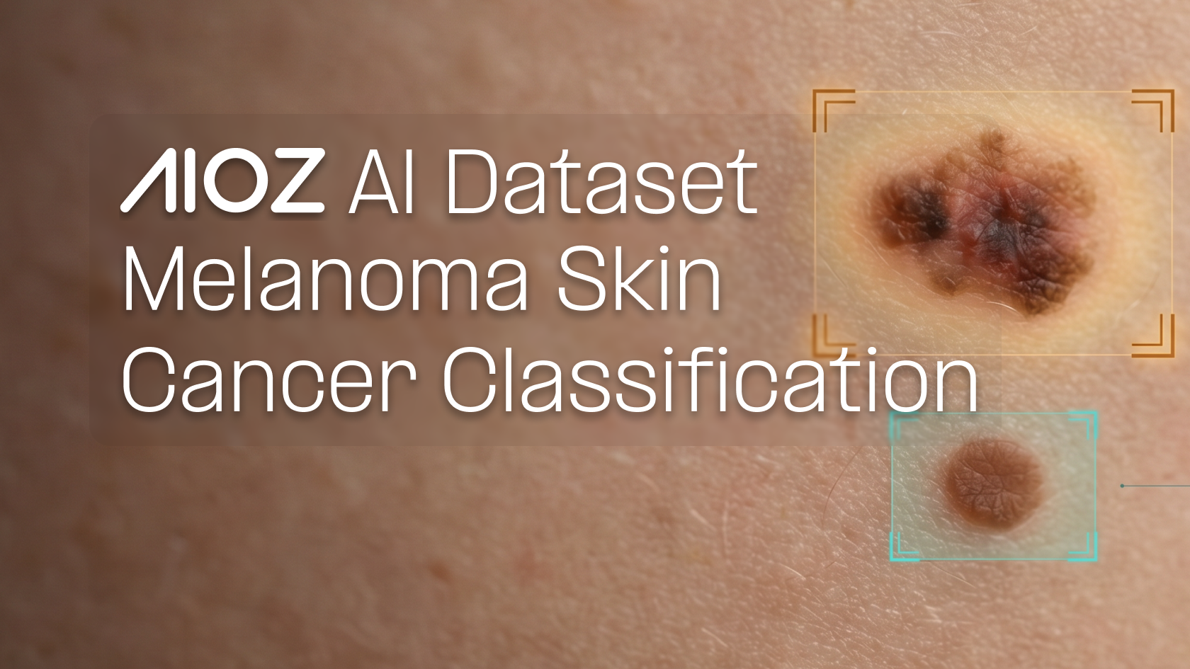 Melanoma_Skin_Cancer_Data